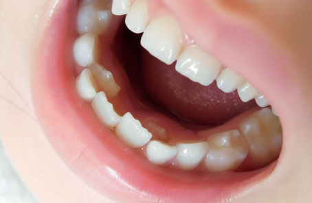 乳歯の後ろに永久歯が生えてきた