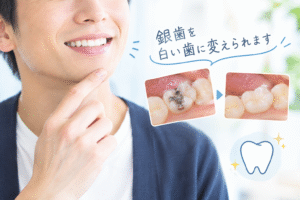 銀歯が気になる方へ